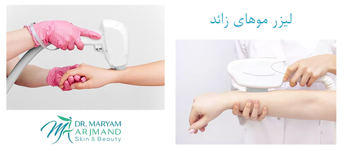 لیزر موهای زائد