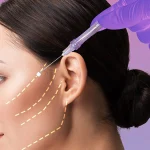 لیفت صورت با نخ