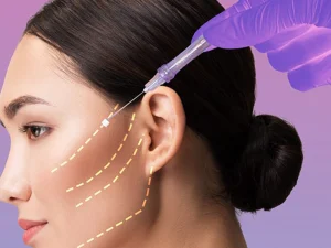 لیفت صورت با نخ