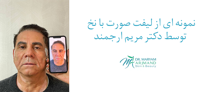 نمونه ای از لیفت صورت با نخ  توسط دکتر مریم ارجمند 