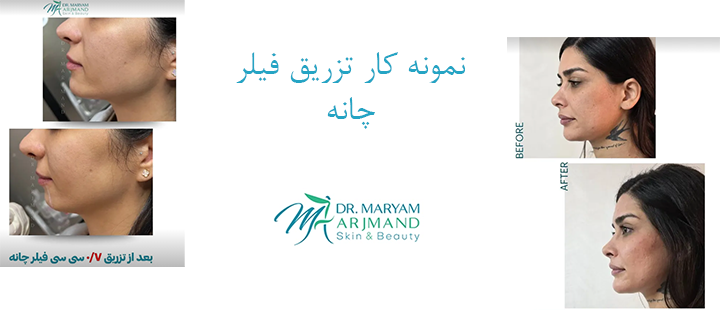 نمونه کار تزریق فیلر چانه