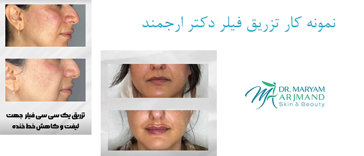 نمونه کار فیلر