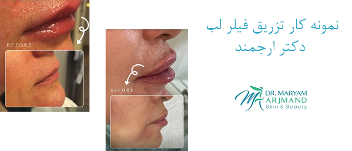 نمونه کار فیلر لب