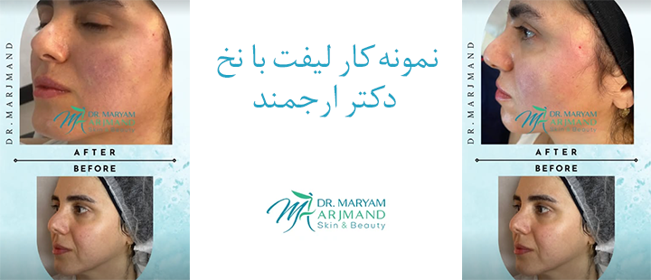 نمونه کار لیفت با نخ دکتر ارجمند 