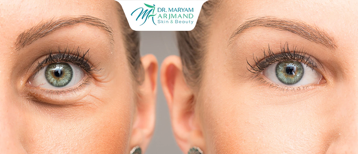 بوتاکس زیر چشم چیست؟