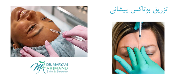 تزریق بوتاکس پیشانی چگونه انجام می‌شود؟