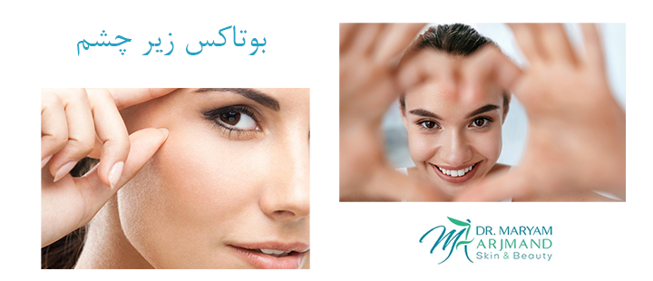 درباره بوتاکس زیر چشم 