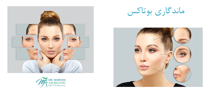 درباره ماندگاری بوتاکس