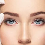 لیفت شقیقه با بوتاکس