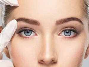 لیفت شقیقه با بوتاکس