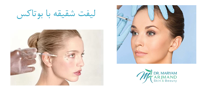 لیفت شقیقه با بوتاکس چگونه انجام می‌شود؟