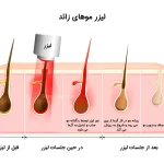 آشنایی با تعداد جلسات لیزر