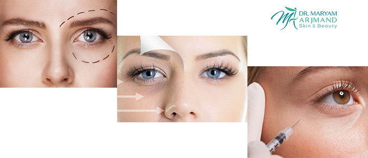 تزریق فیلر زیر چشم چیست؟
