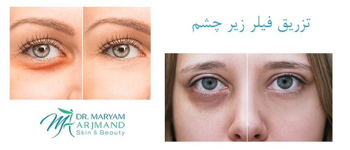 درباره تزریق فیلر زیر چشم