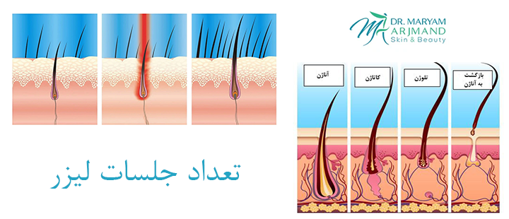 تعداد جلسات لیزر باید چقدر باشد؟