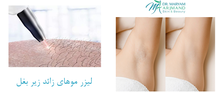 درباره لیزر موهای زائد زیر بغل