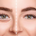 فیلر زیر چشم