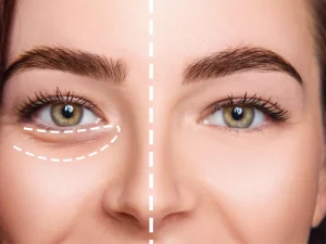 فیلر زیر چشم