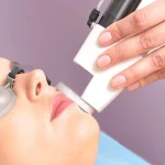 لیزر موهای زائد صورت