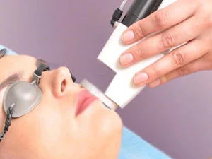 لیزر موهای زائد صورت