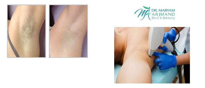 لیزر موی زائد زیر بغل چگونه انجام می‌شود؟