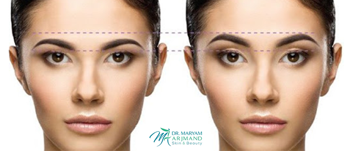 آشنایی با لیفت با نخ