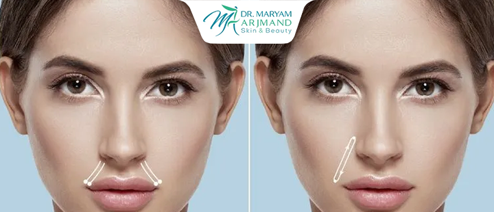 آشنایی با لیفت با نخ برای رفع خط خنده