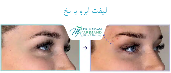 درباره لیفت ابرو با نخ 
