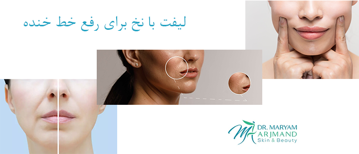 درباره لیفت با نخ برای رفع خط خنده
