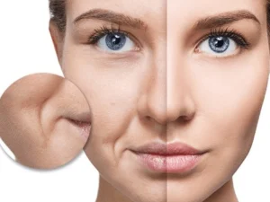 لیفت با نخ برای رفع خط خنده