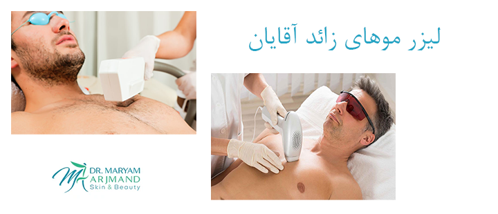 آشنایی با لیزر موهای زائد آقایان