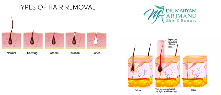 آشنایی با ماندگاری لیزر موهای زائد