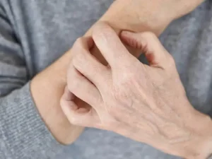 خارش پوست بعد از لیزر