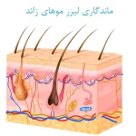 ماندگاری لیزر موهای زائد