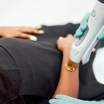 آشنایی با علت ریزش مو بعد از لیزر موهای زائد