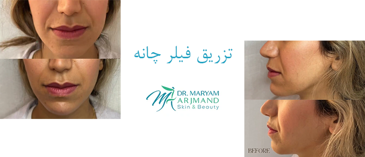 درباره تزریق فیلر چانه