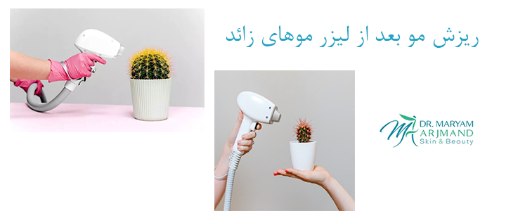 درباره ریزش مو بعد از لیزر موهای زائد