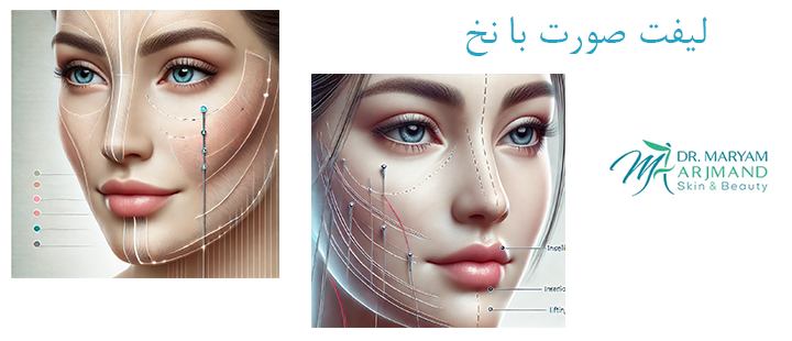درباره لیفت صورت با نخ 