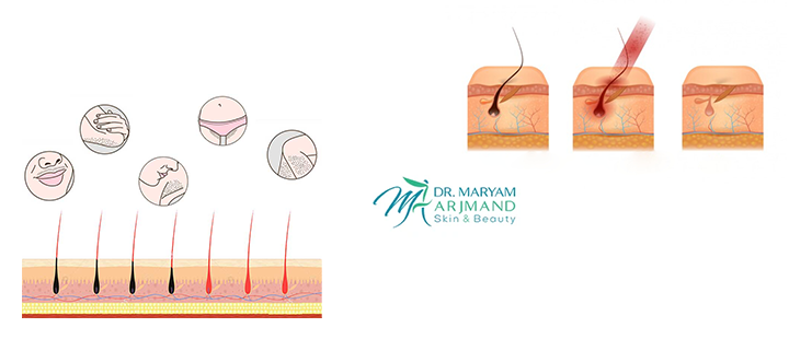 آشنایی با ریزش مو بعد از لیزر موهای زائد