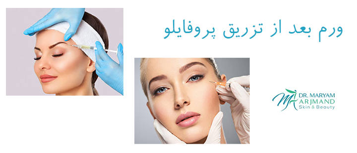 درباره ورم بعد از تزریق پروفایلو