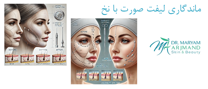 ماندگاری لیفت صورت با نخ چقدر است؟