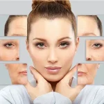 هزینه لیفت صورت با نخ