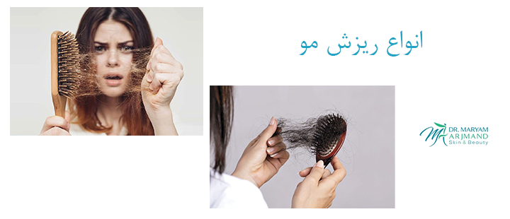 انواع ریزش مو