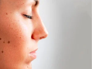 برداشتن خال