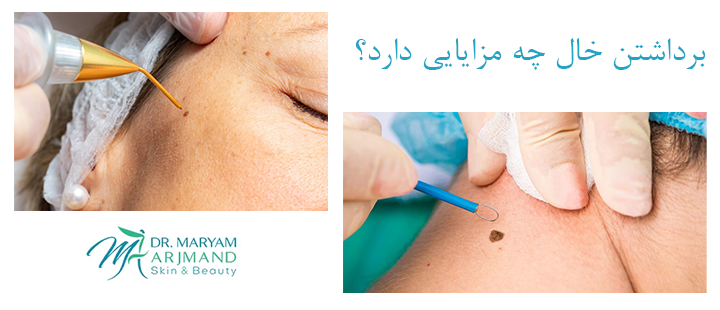 برداشتن خال چه مزایایی دارد؟