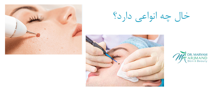 خال چه انواعی دارد؟
