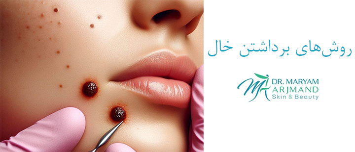 روش های برداشتن خال 