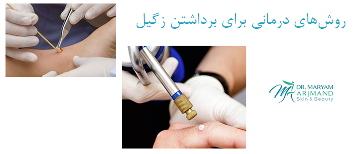 روش‌های درمانی برای برداشتن زگیل
