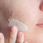 مراقبت های بعد از برداشتن خال