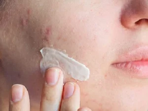 مراقبت های بعد از برداشتن خال